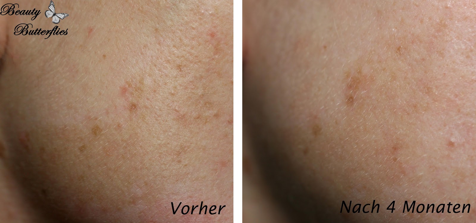 Als es unterscheidet sich das Muttermal von den Sommersprossen